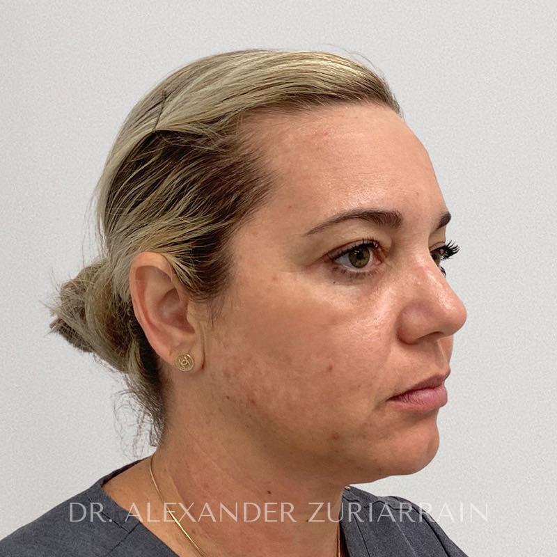 Facial fat grafting before & after photo