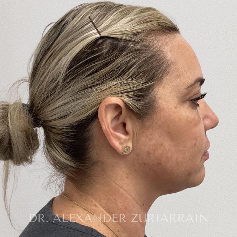 Facial fat grafting before & after photo