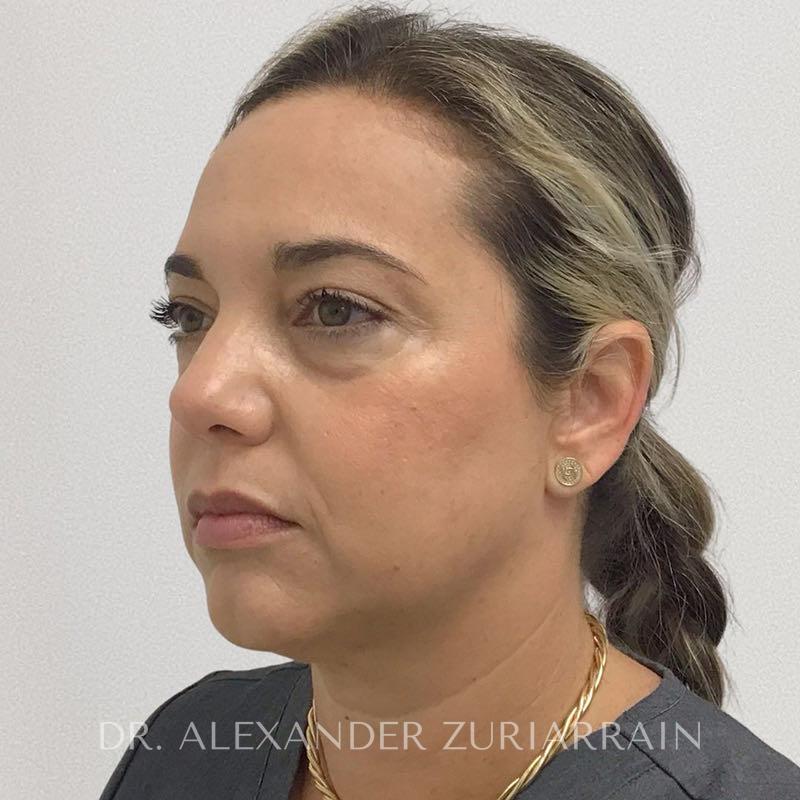Facial fat grafting before & after photo