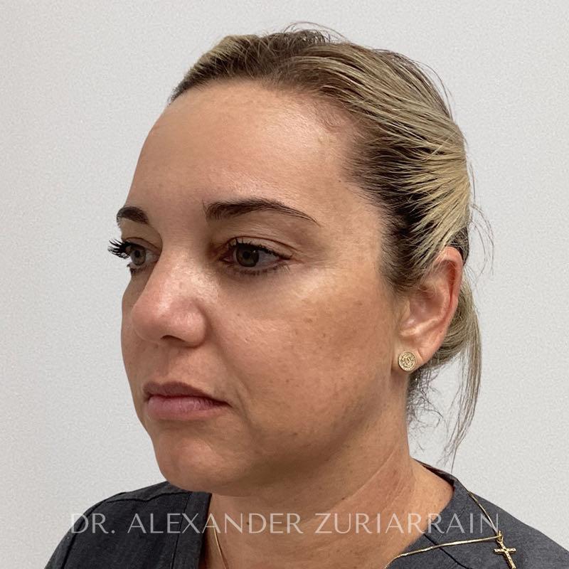 Facial fat grafting before & after photo