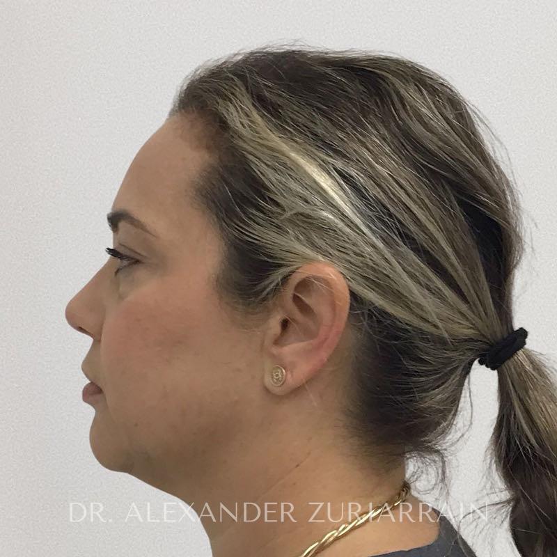 Facial fat grafting before & after photo
