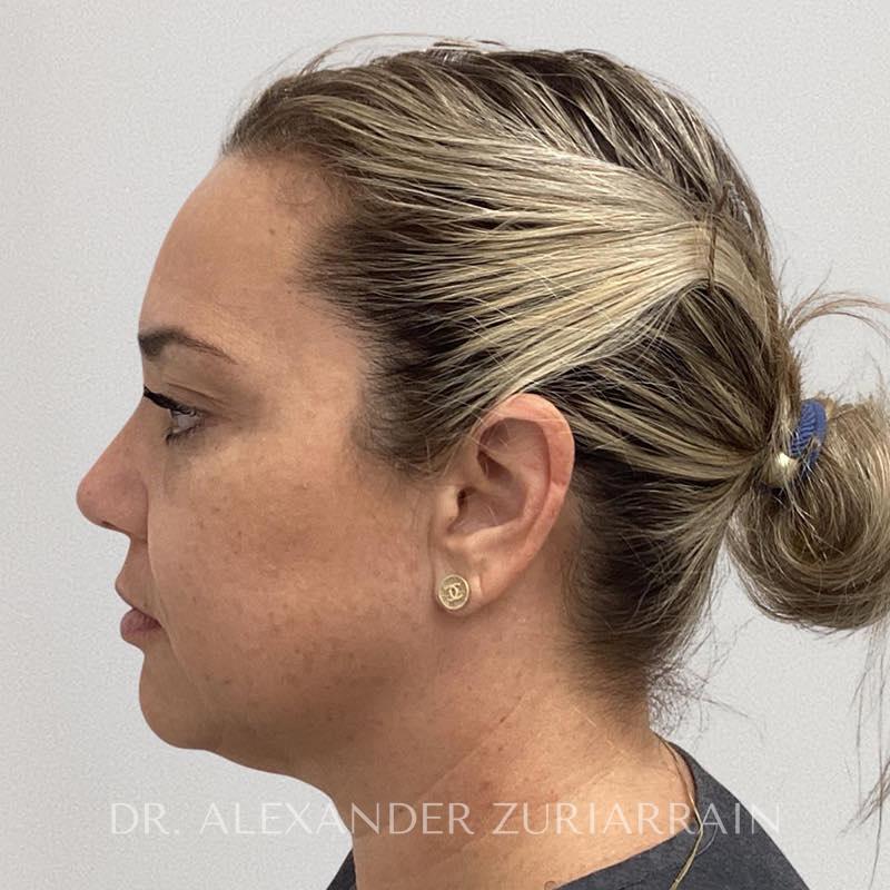 Facial fat grafting before & after photo