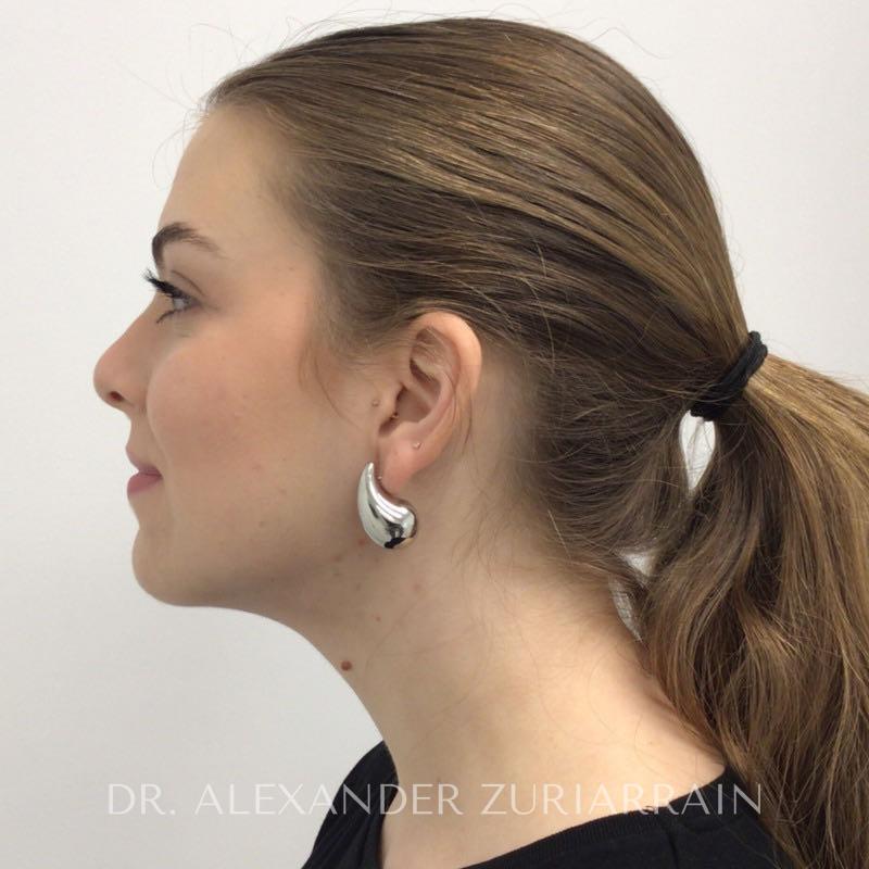 Facial fat grafting before & after photo