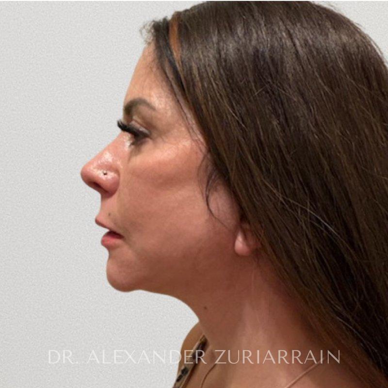 Facial fat grafting before & after photo