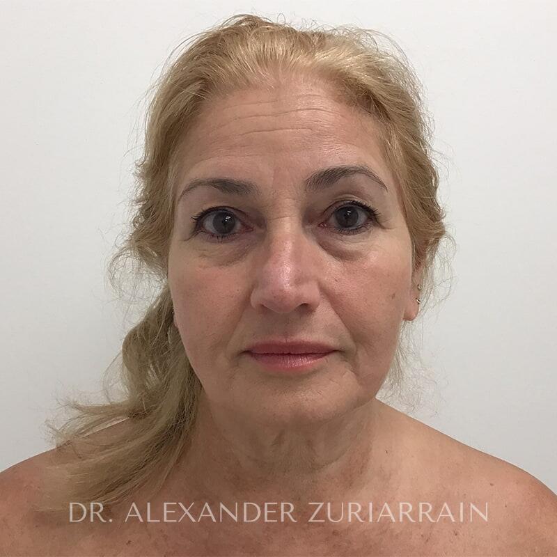 Neck lift before & after photo