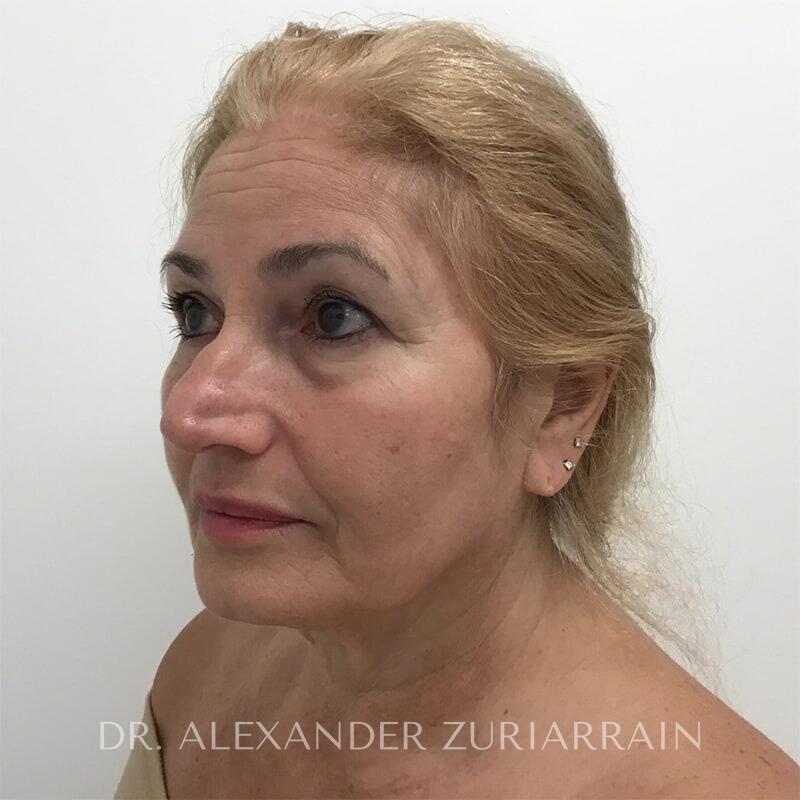 Neck lift before & after photo