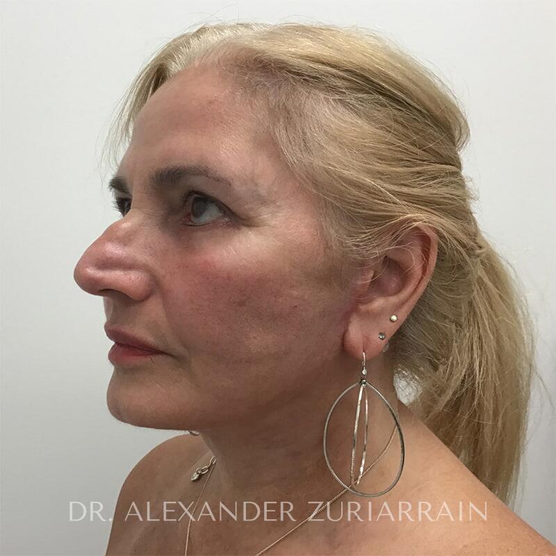 Neck lift before & after photo