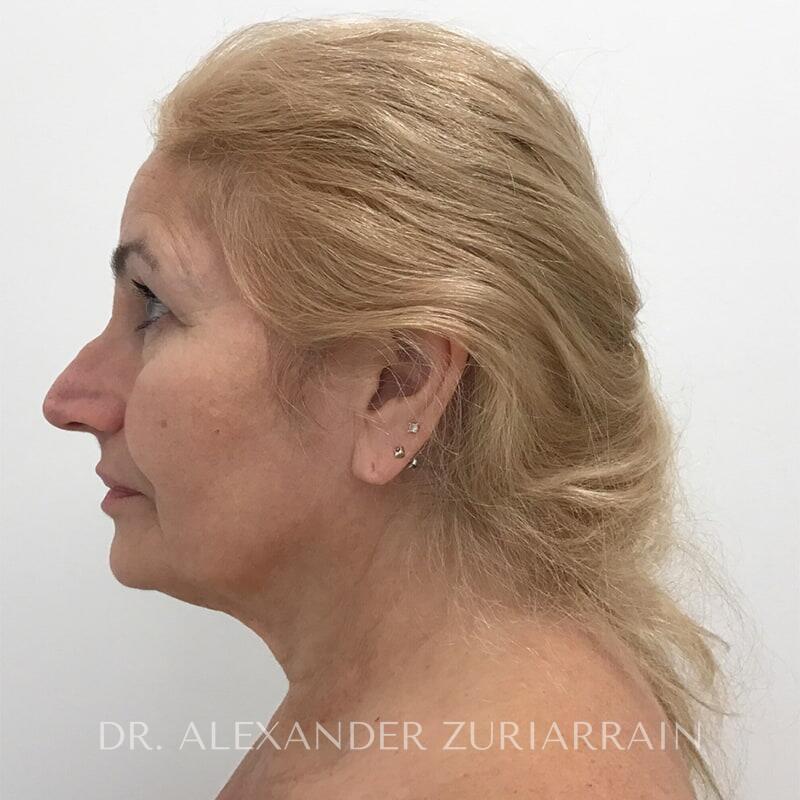 Neck lift before & after photo