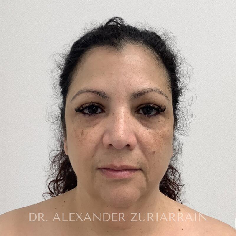 Neck lift before & after photo