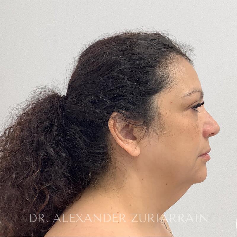 Neck lift before & after photo