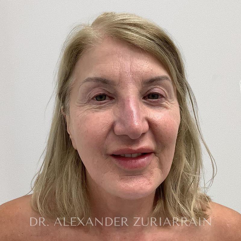 Neck lift before & after photo