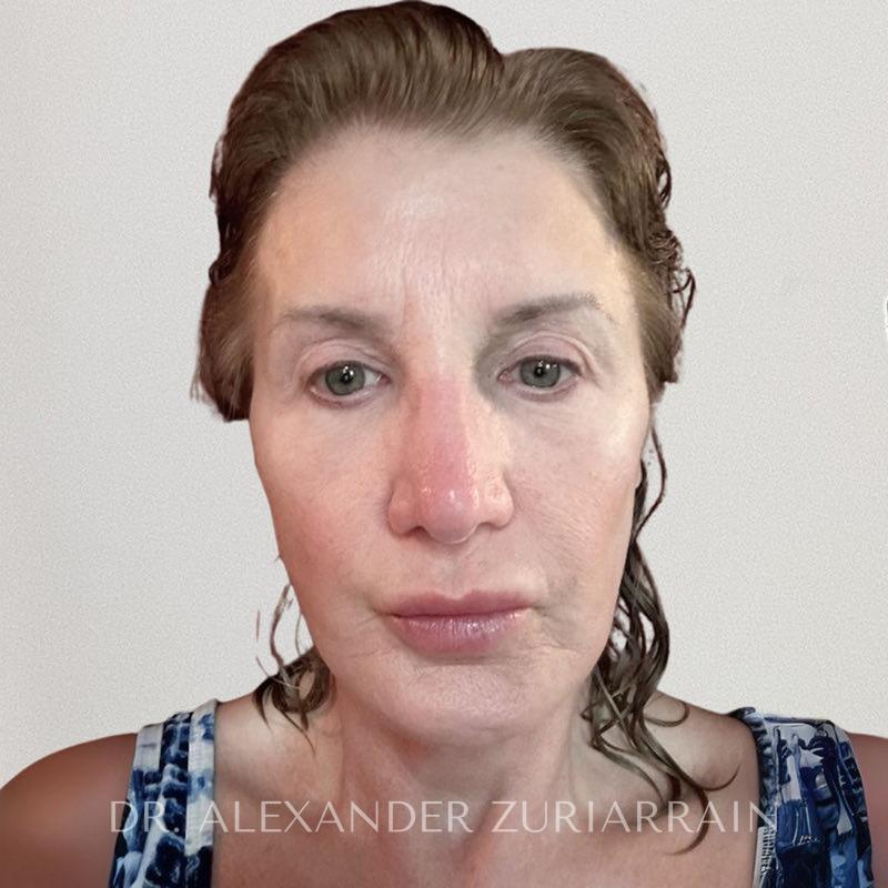 Neck lift before & after photo
