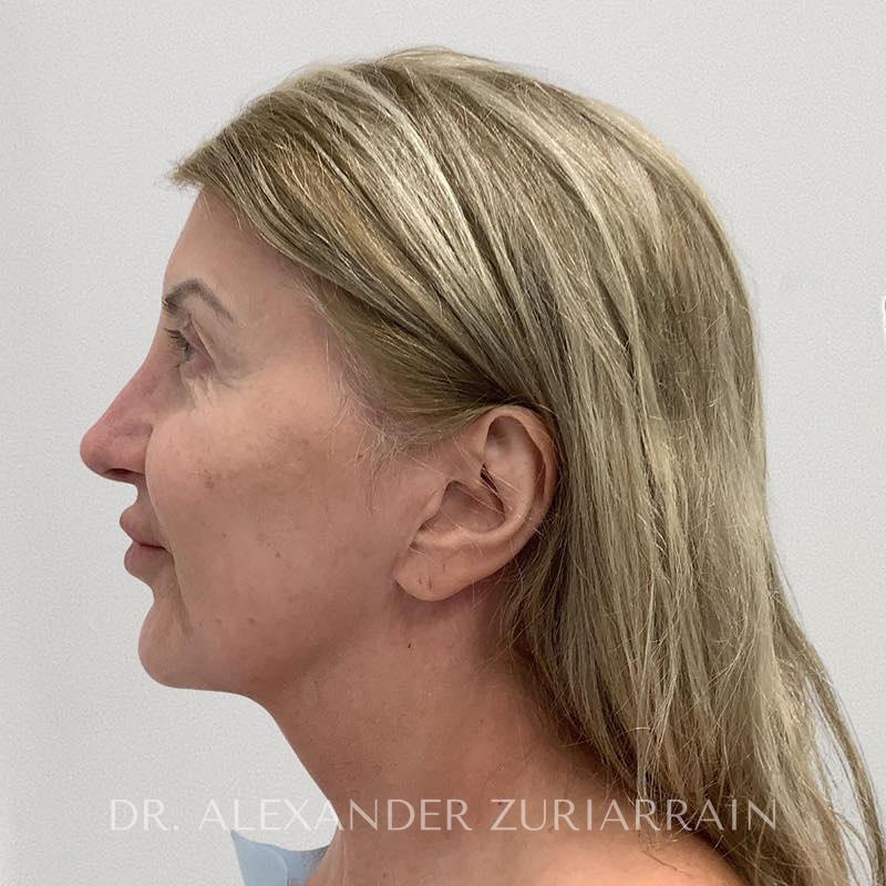 Neck lift before & after photo