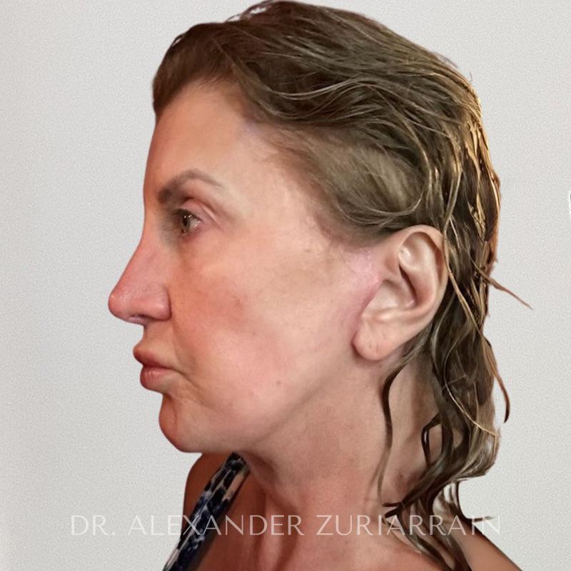 Neck lift before & after photo