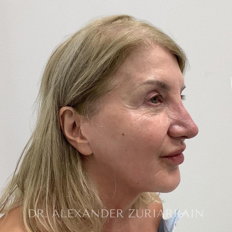 Neck lift before & after photo