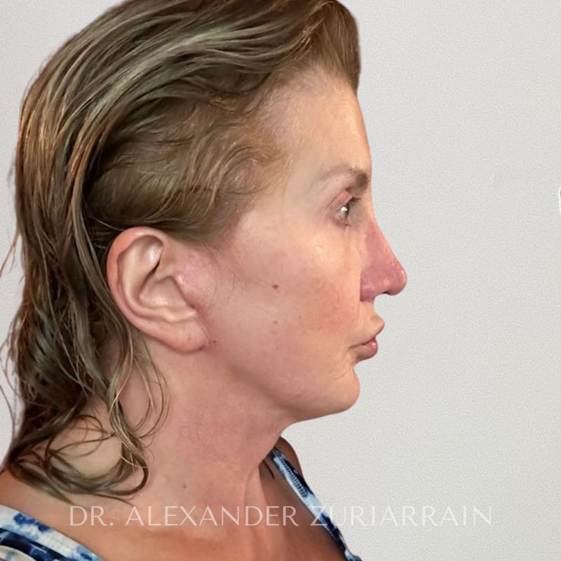 Neck lift before & after photo