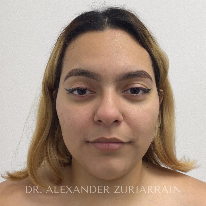 Submental liposuction before & after photo