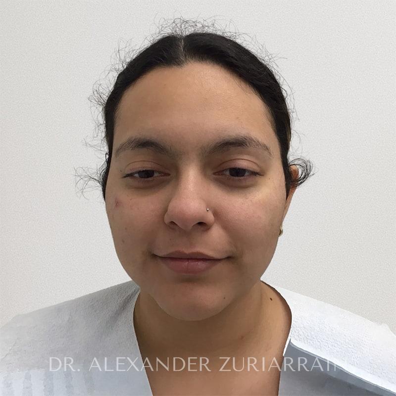 Submental liposuction before & after photo