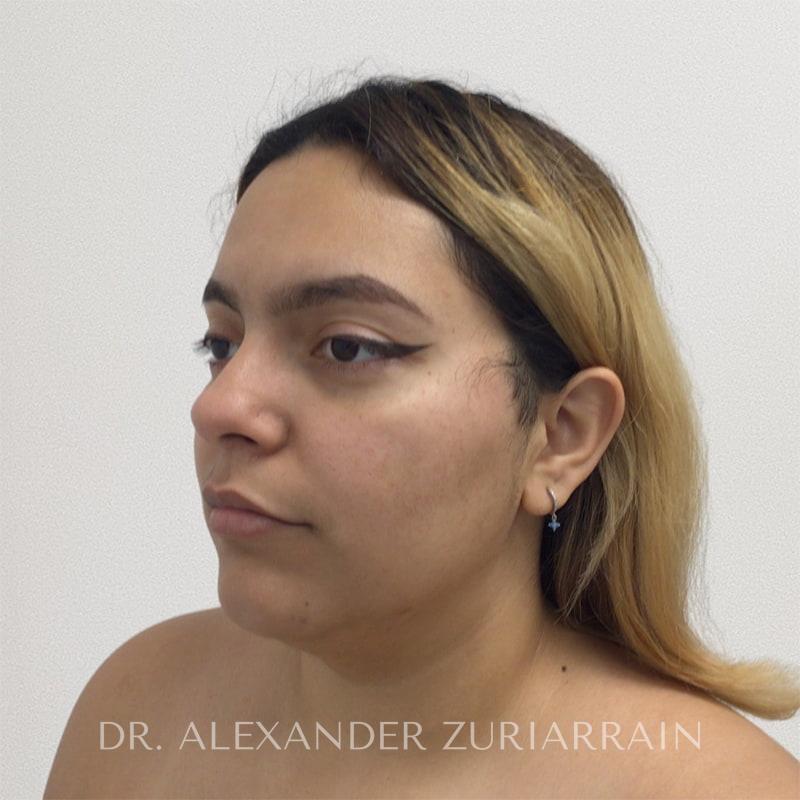 Submental liposuction before & after photo