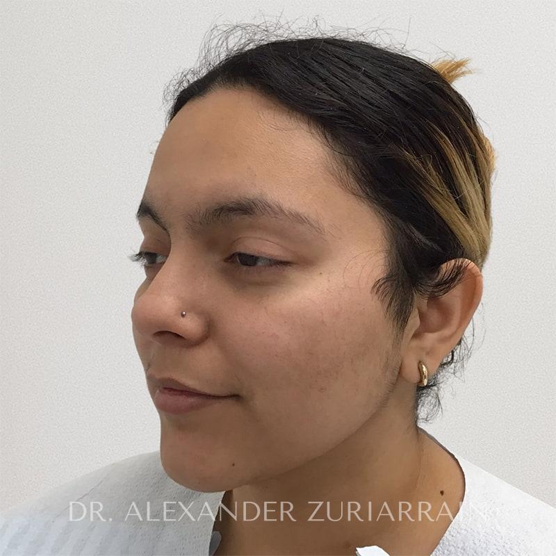 Submental liposuction before & after photo