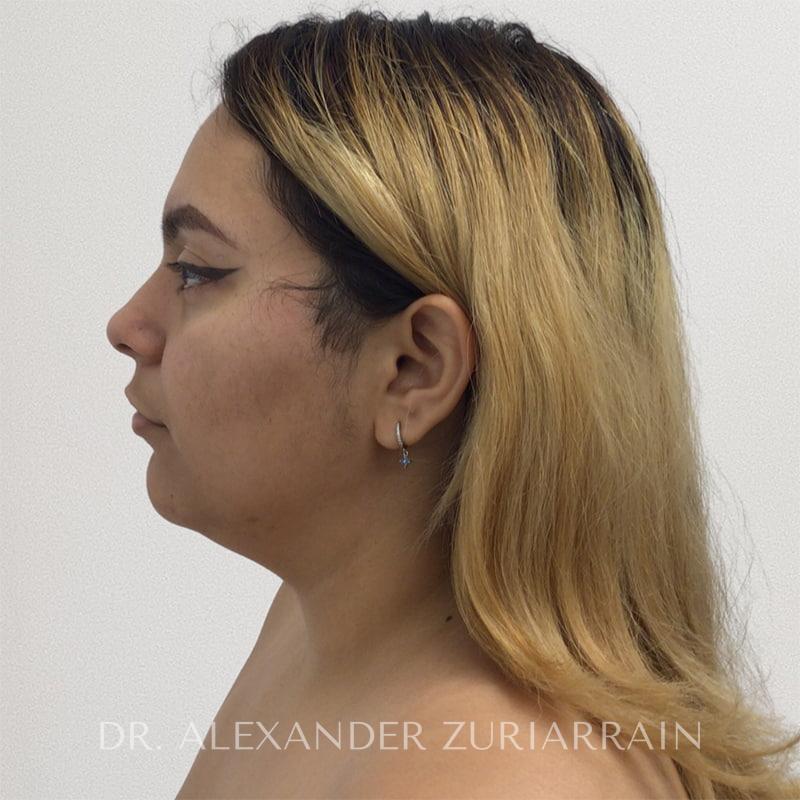 Submental liposuction before & after photo