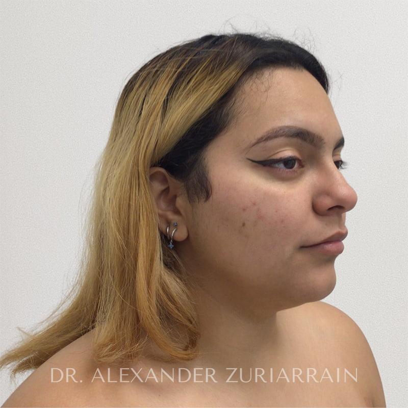 Submental liposuction before & after photo
