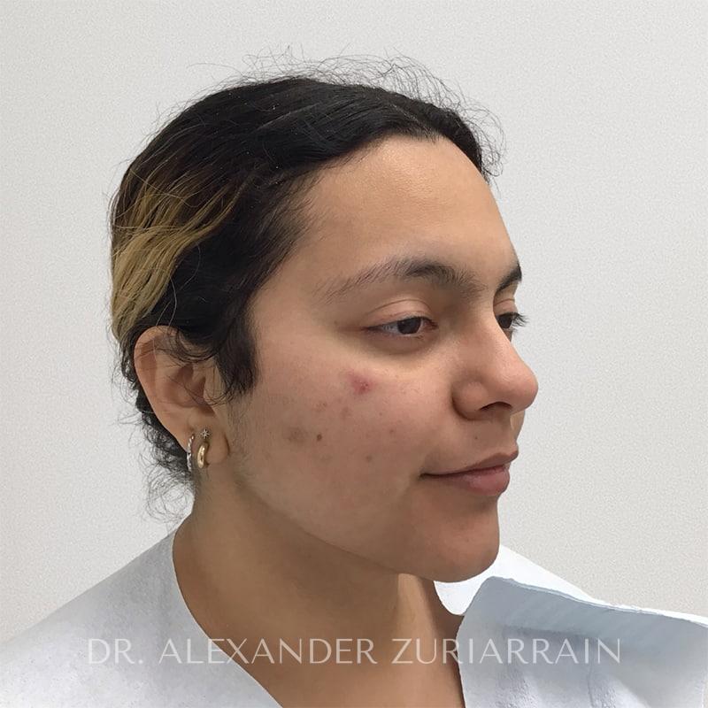 Submental liposuction before & after photo