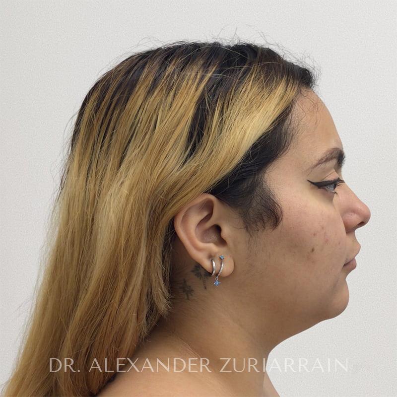 Submental liposuction before & after photo