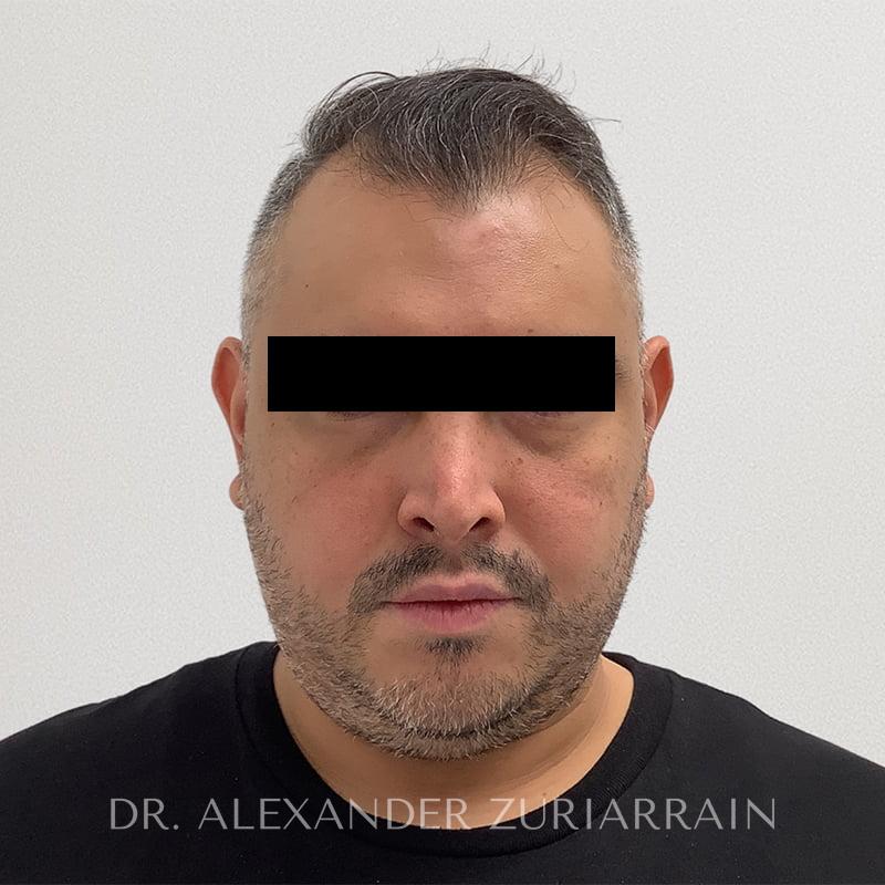 Submental liposuction before & after photo