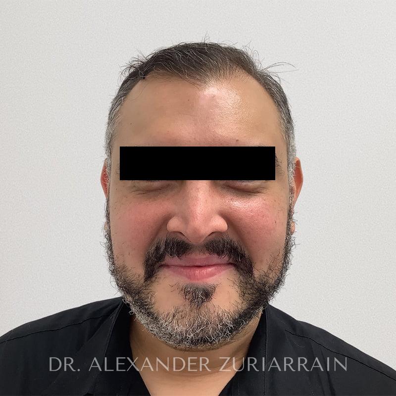 Submental liposuction before & after photo