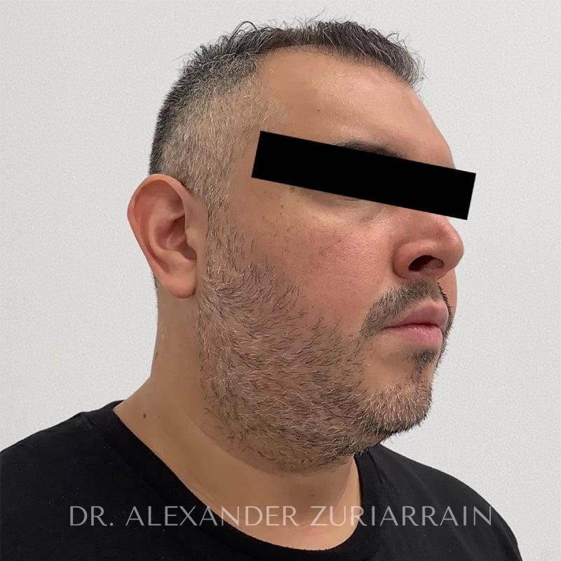 Submental liposuction before & after photo