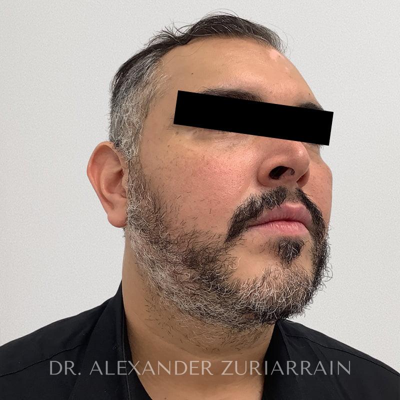 Submental liposuction before & after photo