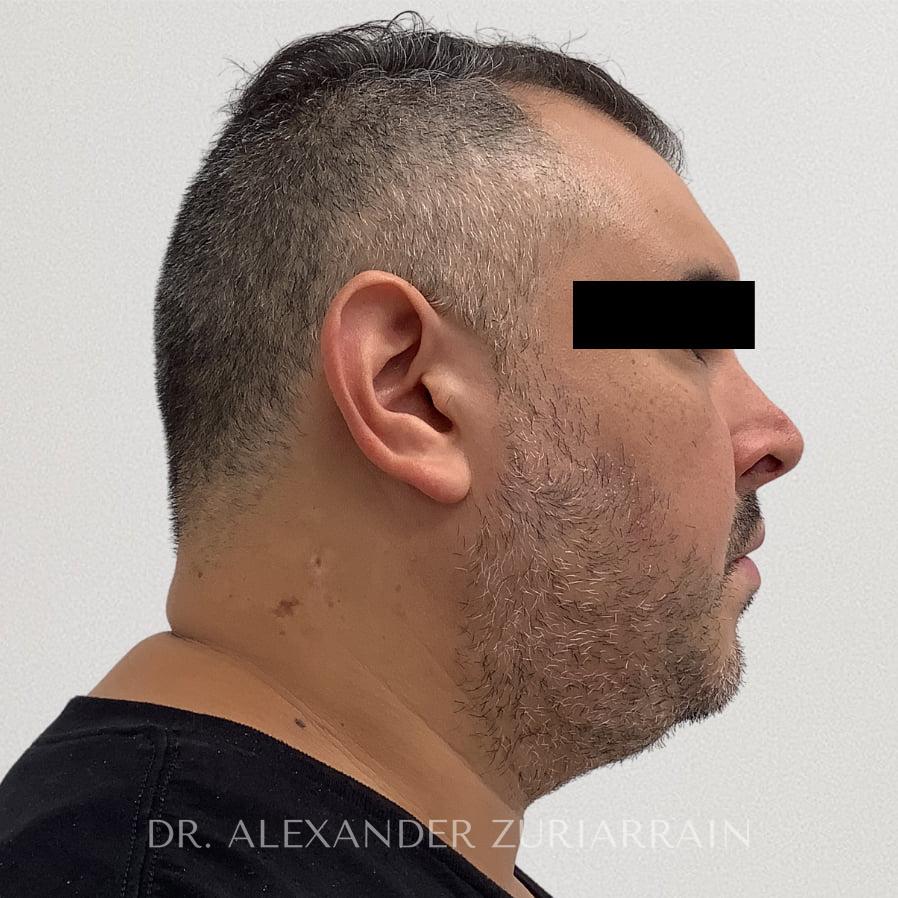 Submental liposuction before & after photo