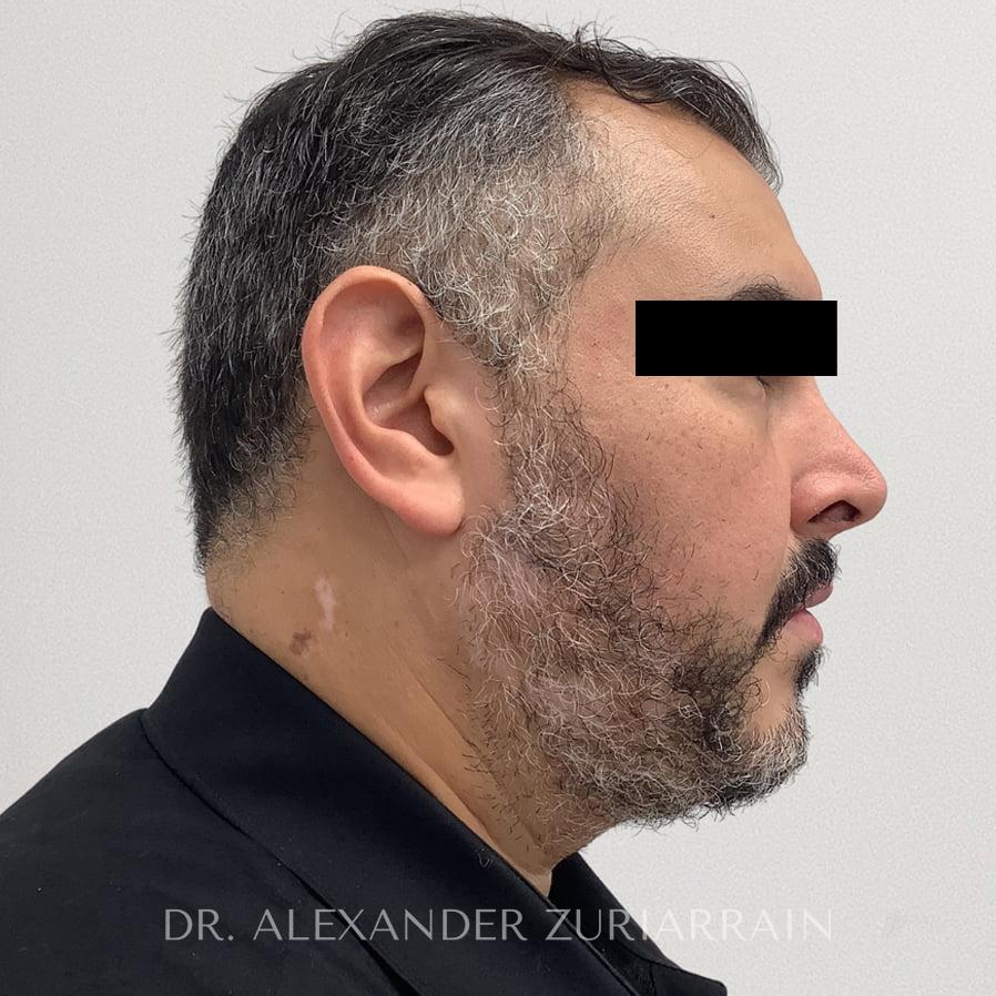 Submental liposuction before & after photo