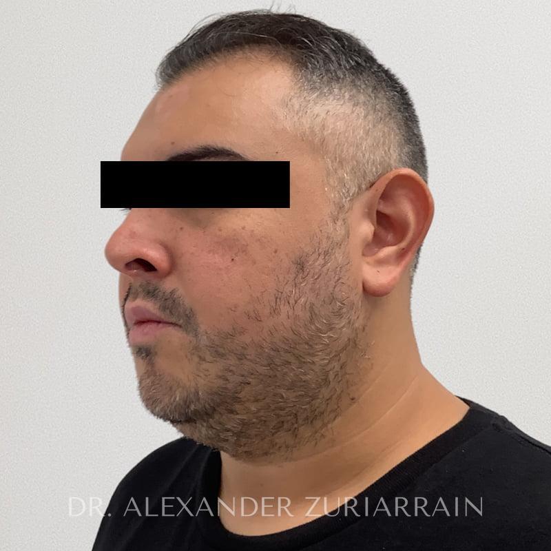Submental liposuction before & after photo