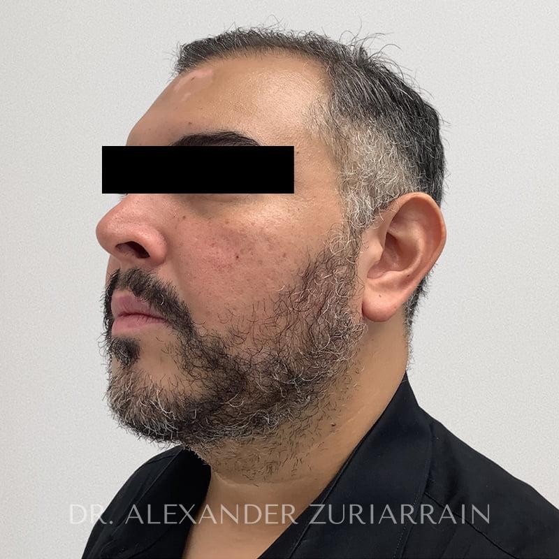 Submental liposuction before & after photo
