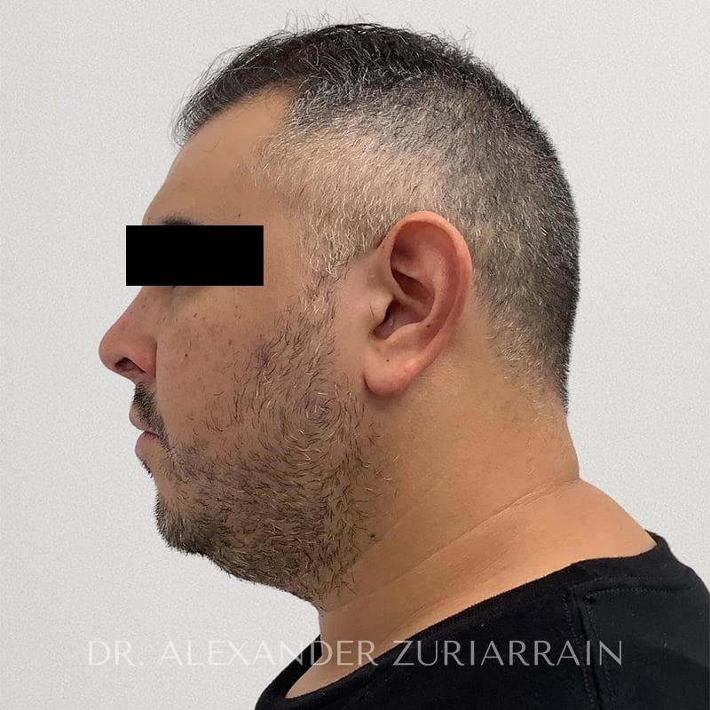 Submental liposuction before & after photo