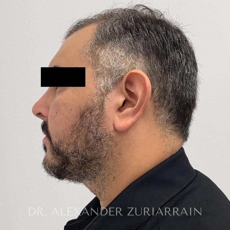 Submental liposuction before & after photo