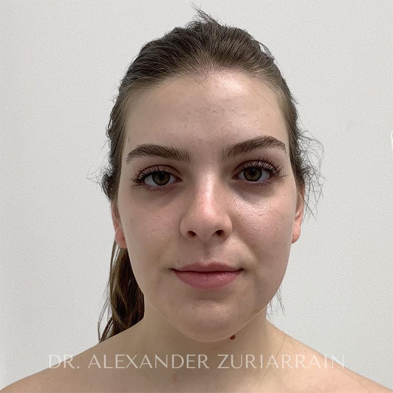 Submental liposuction before & after photo