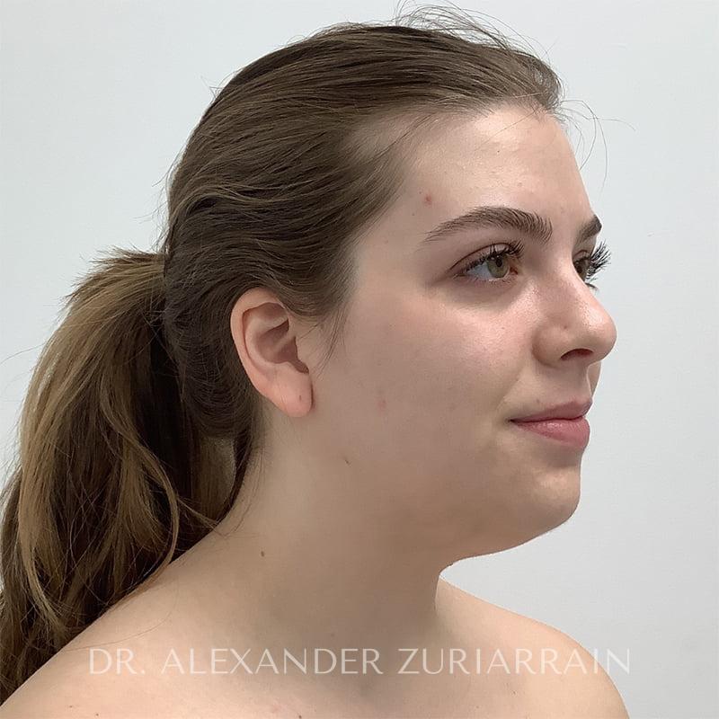 Submental liposuction before & after photo