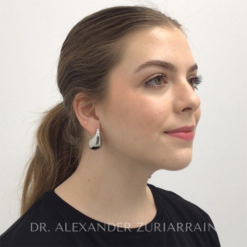 Submental liposuction before & after photo