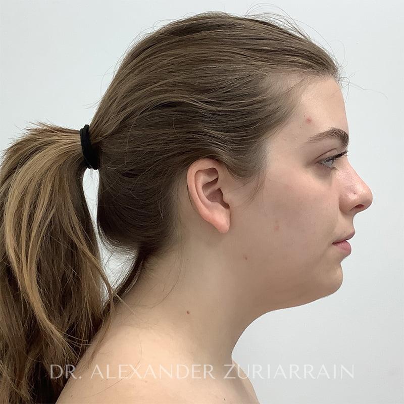 Submental liposuction before & after photo