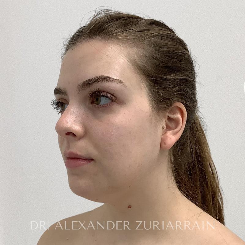 Submental liposuction before & after photo