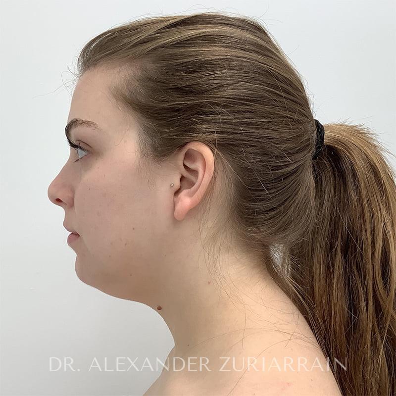 Submental liposuction before & after photo
