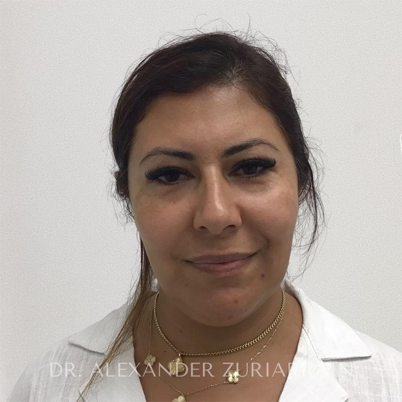 Submental liposuction before & after photo
