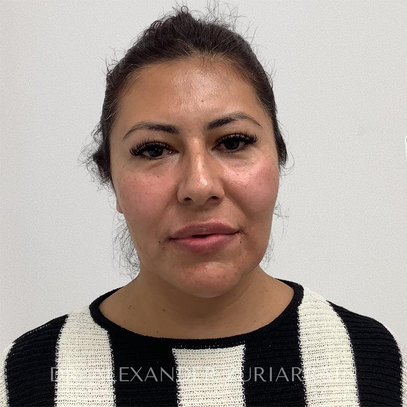 Submental liposuction before & after photo
