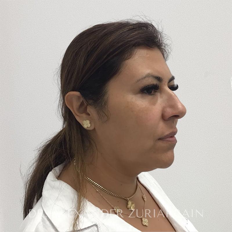 Submental liposuction before & after photo