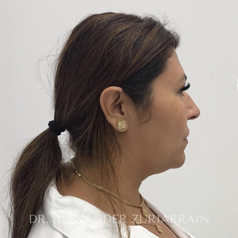 Submental liposuction before & after photo