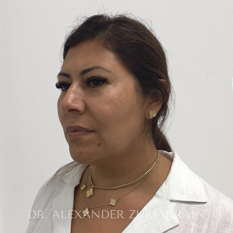 Submental liposuction before & after photo