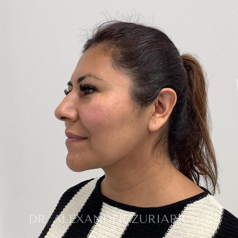 Submental liposuction before & after photo